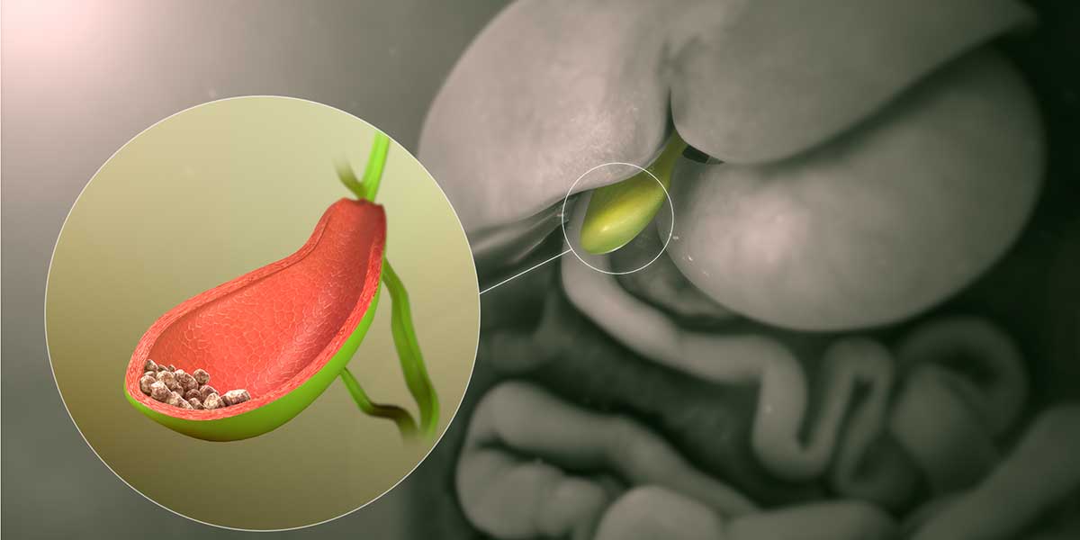 Gall Stones - Top 10 Frequently Asked Questions