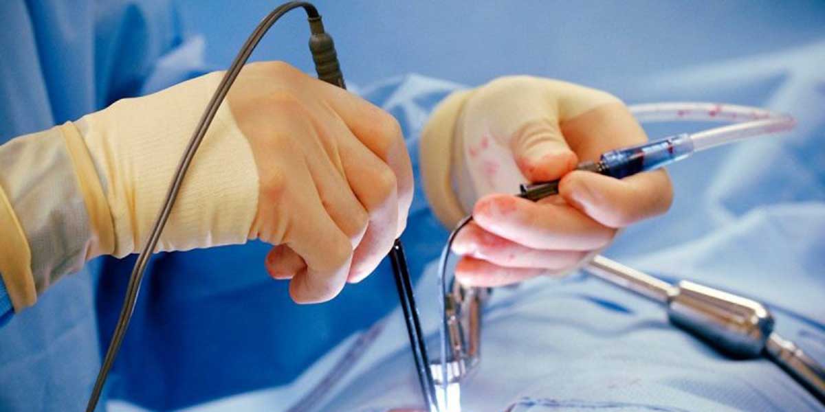 Advantages and Disadvantages of Laser Piles Treatment