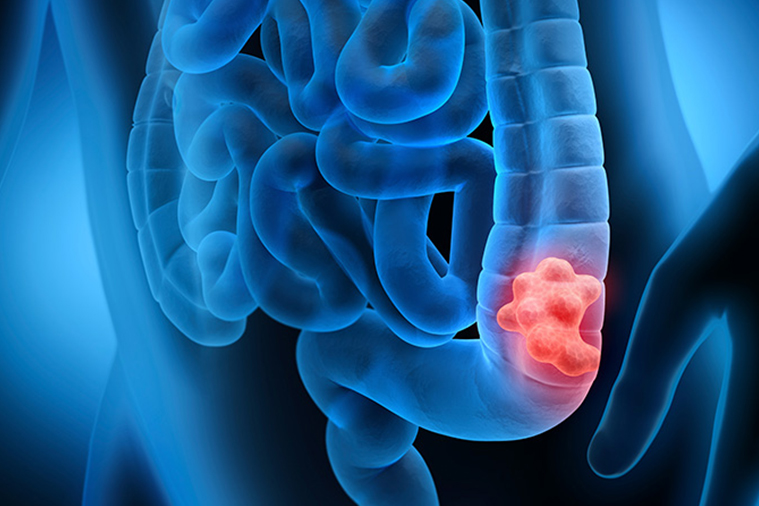 Colorectal Cancer Treatment