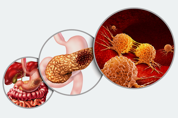 Pancreatic Cancer Treatment