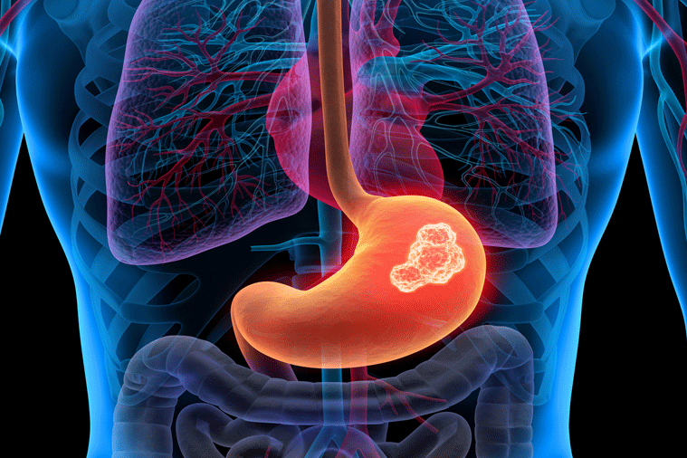 Stomach Cancer Treatment