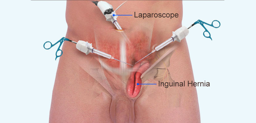 Laparoscopic Vs. Open Hernia Repair