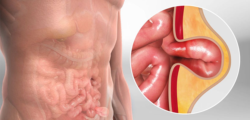 Internal Hernia Images