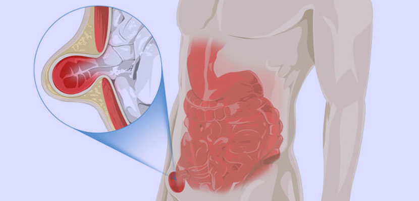 Different types of Hernia