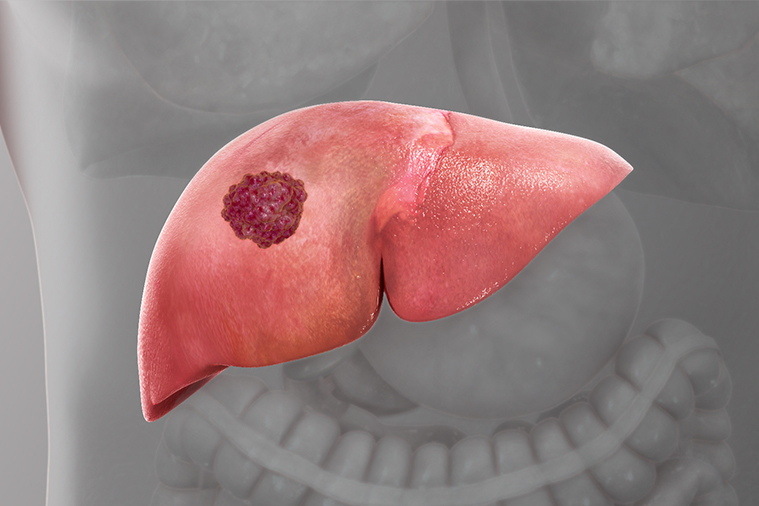 Liver Cancer Liver Cancer