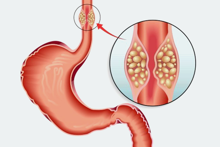 esophageal cancer treatment