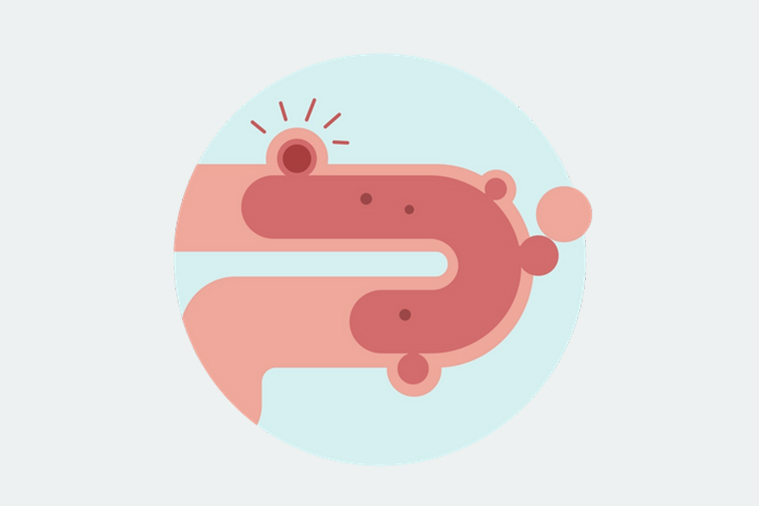 treatment for diverticulitis treatment for diverticulitis