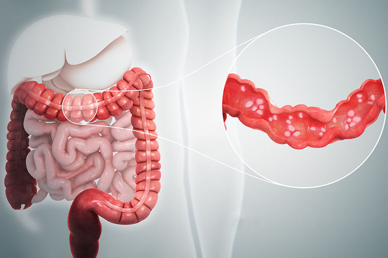 ulcerative colitis treatment