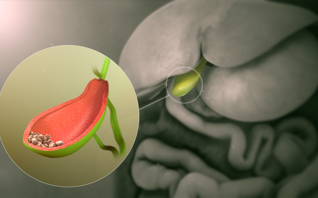 Gallstones: Navigating Your Diet for a Healthy Gallbladder